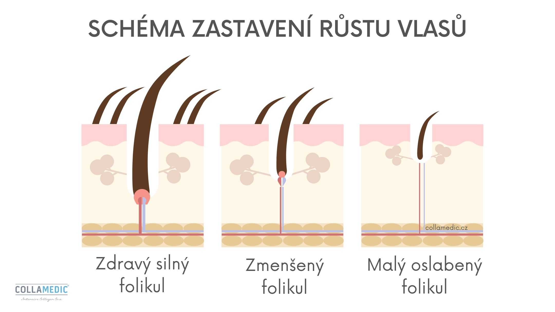 Schéma vypadávání vlasů - zastavení růstu vlasů